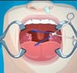 Operate Now: Tonsil Surgery