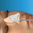 Virtual Closed Rhinoplasty