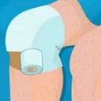 Operate Now Knee Surgery