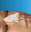 Virtual Closed Rhinoplasty